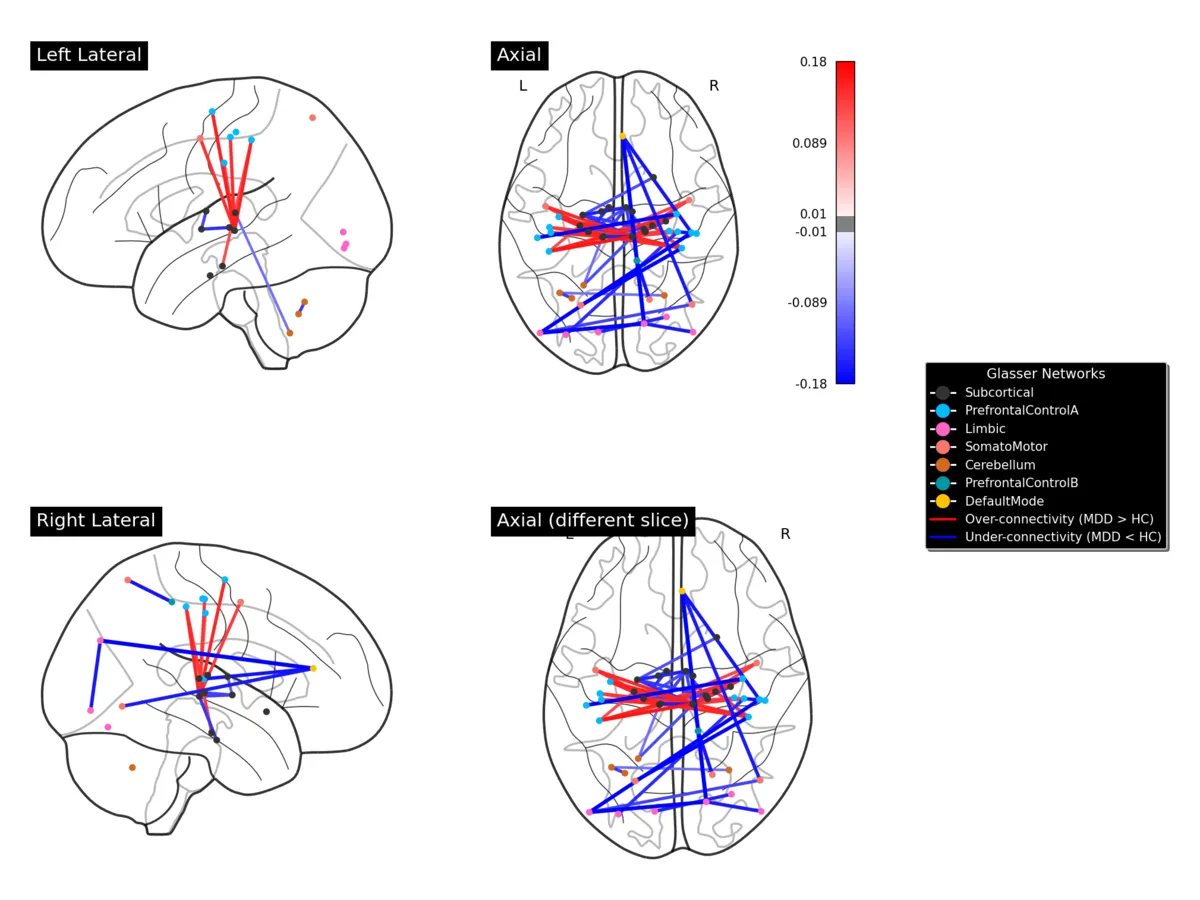 Brain connectivity views of the PCA biomarker consensus from the thesis