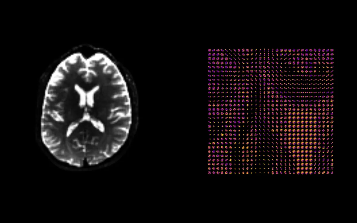 Diffusion MRI slice and reconstructed GQI orientation distribution functions